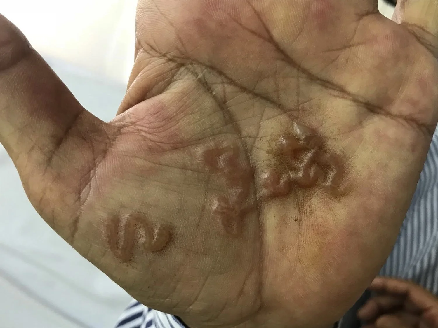 Giun đào hầm, ngoáy lộn dưới da người bị nhiễm giun, sán từ thú cưng (2)