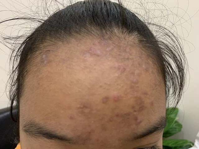 Nhiễm sán chó gây chàm da bụng ở bệnh nhân nam 32 tuổi