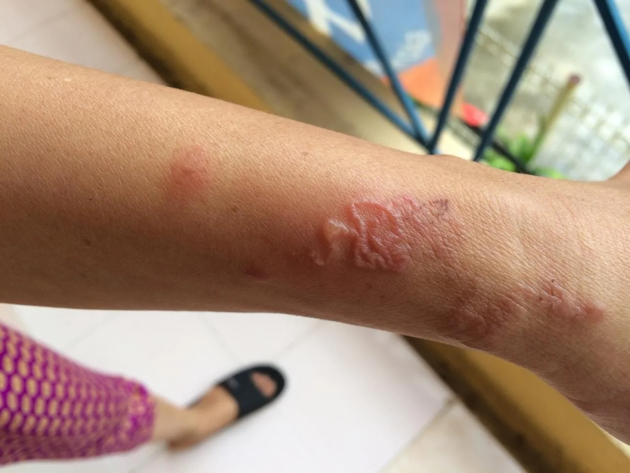 Giun đào hầm, ngoáy lộn dưới da người bị nhiễm giun, sán từ thú cưng