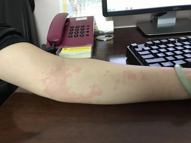 Sán chó Những Dấu Hiệu Của Bệnh Sán Chó Chớ Nên Xem Thường