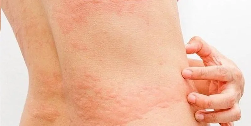 Bệnh sán chó: Nguyên nhân, dấu hiệu và cách phòng bệnh - Nhà thuốc FPT Long Châu