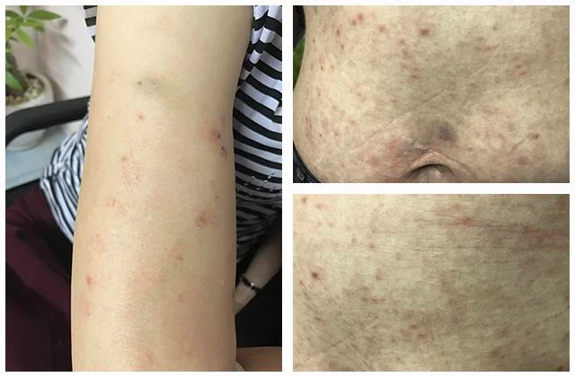 Nhiễm Sán Chó: Điều Trị Ở Đâu Bao Lâu Khỏi Bệnh