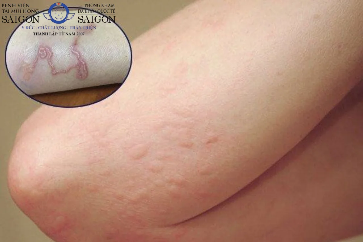 Những dấu hiệu khi bị nhiễm sán chó và cách điều trị bệnh