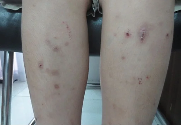 Điều Trị Bệnh Sán Chó Ở Người
