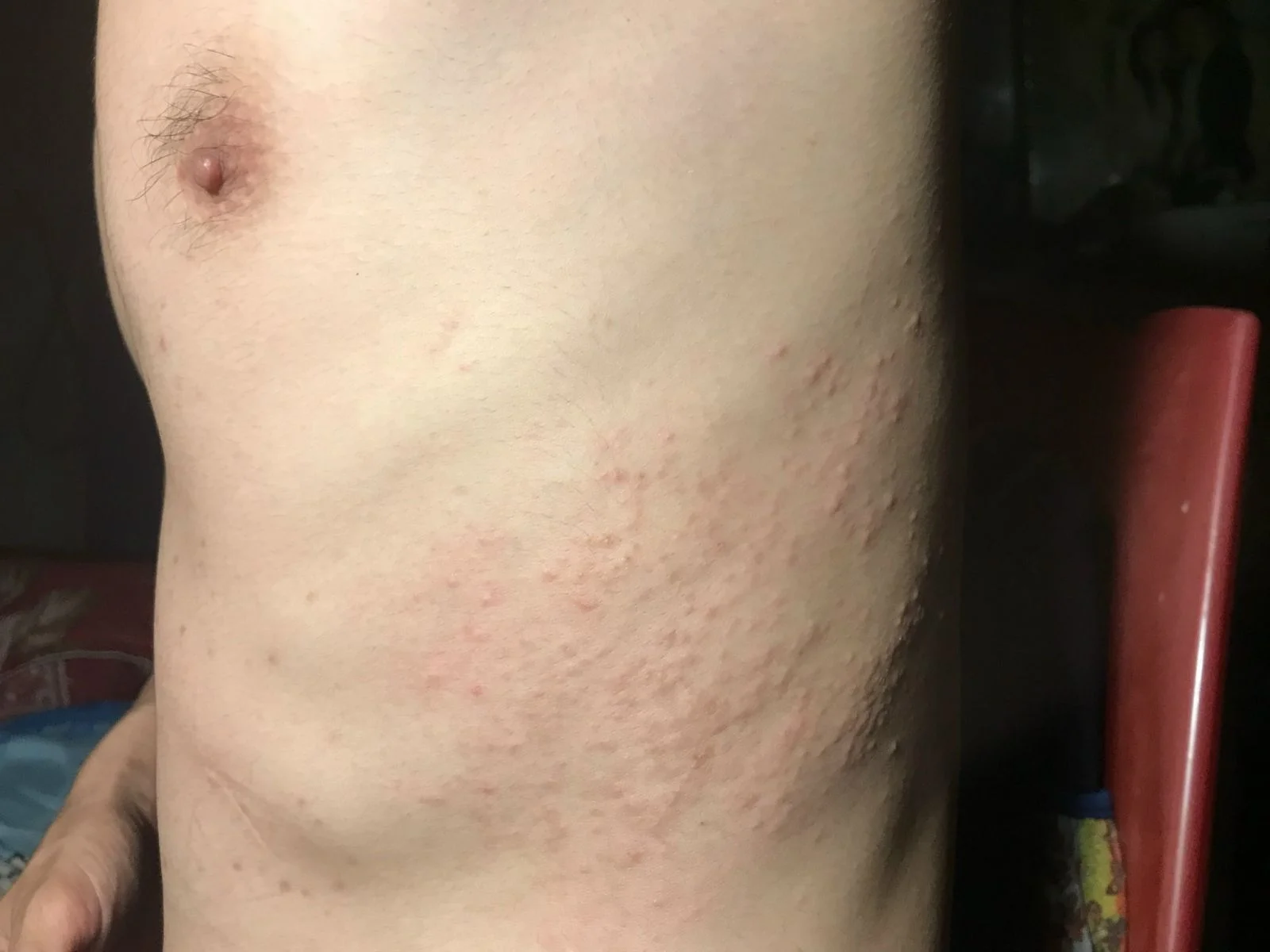 Bệnh Sán Chó? Triệu Chứng Bệnh Sán Chó?
