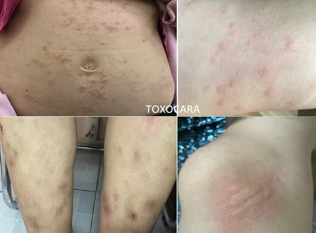 Sán chó Những Dấu Hiệu Của Bệnh Sán Chó Chớ Nên Xem Thường (2)